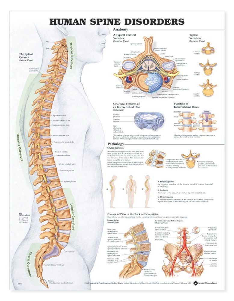 Wolter Kluwer Health Inc - 9781587793998 Anatomical Chart Spine Disorders 20 X 26 Inch Heavy Paper Grommets Laminated