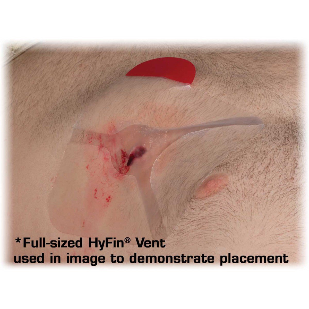 Hyfin Vent Compact Chest Wound Seal 10-0042 by North American Rescue