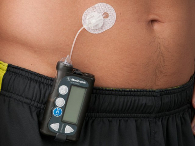 SilhouetteParadigm Insulin Infusion Set MMT-378A by Medtronic