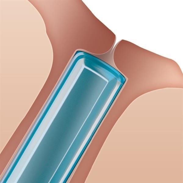 Oasis - 6402 Eye Punctal Plug SOFT PLUG® Extended Duration Absorable Synthetic Medium Occlusion Duration 2 mm Length 0.2 mm Diameter