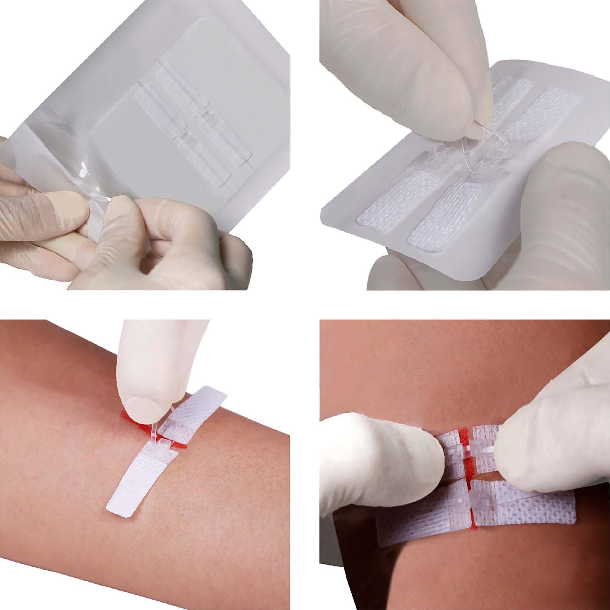 DermaClip US LLC - 62001 Non-Invasive Skin Closure DermaClip® 1 Inch X 11 mm Polypropylene Ventilated Strip Clear