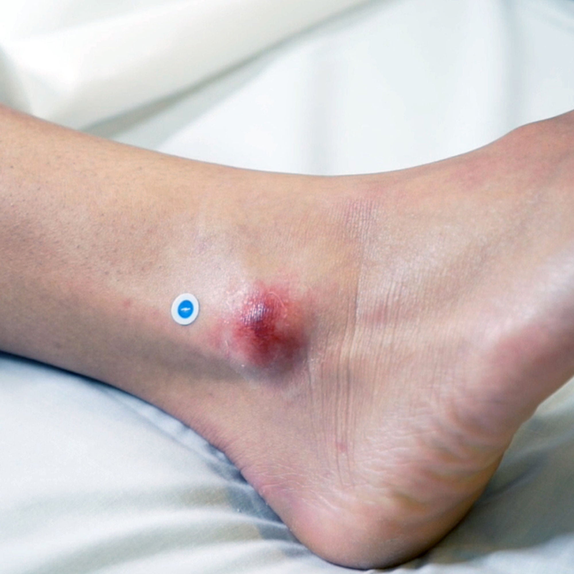 Swift Medical Inc - HHP5018 Calibrant HealX For Wound Care Photos