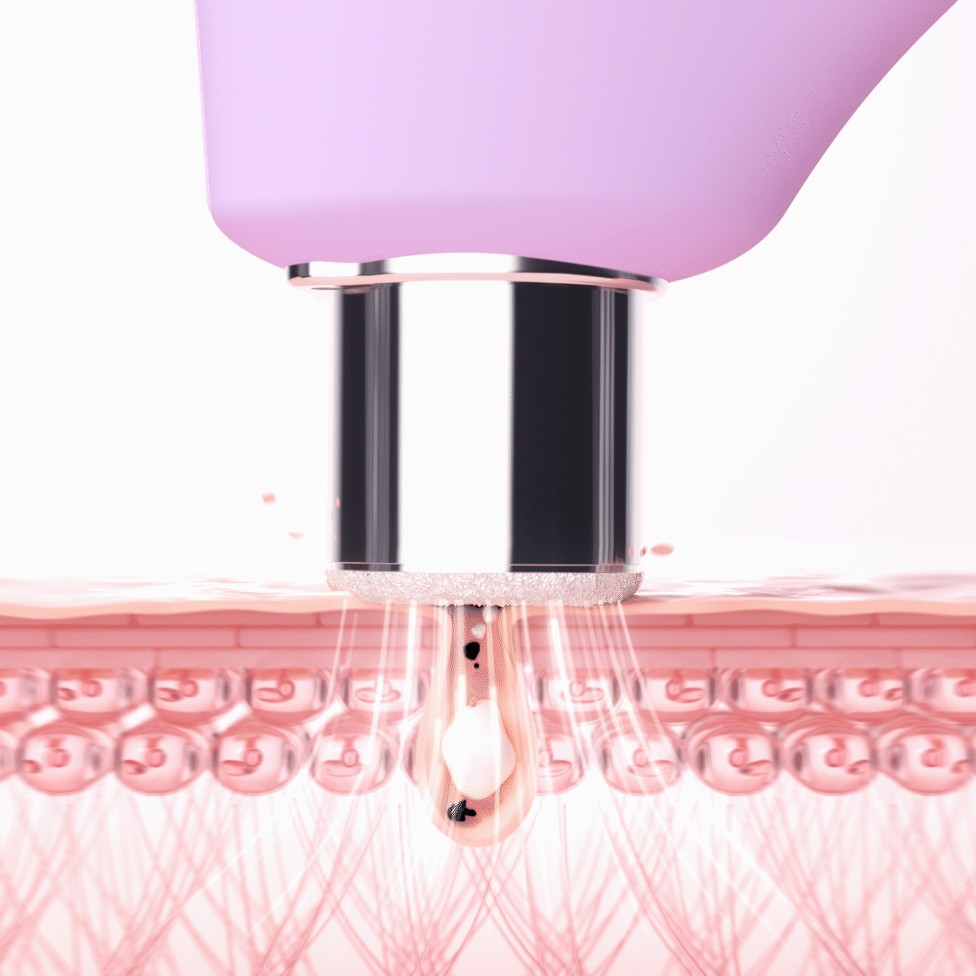 Foreo Inc F1955 - KIWI™ derma Microdermabrasion Pore Vacuum - 1/Each