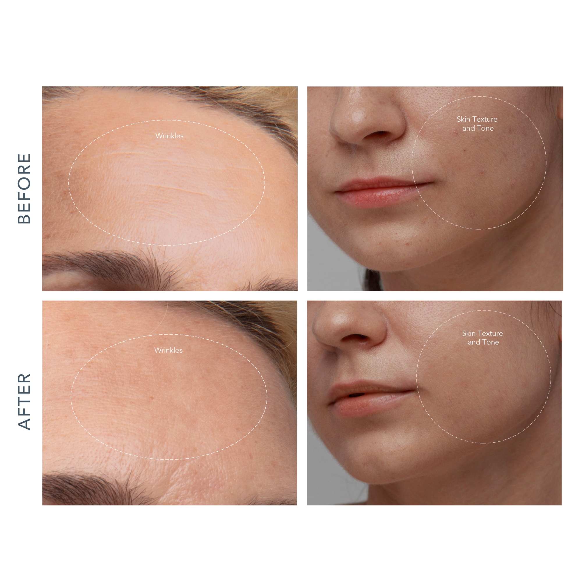 Foreo Inc F1955 - KIWI™ derma Microdermabrasion Pore Vacuum - 1/Each