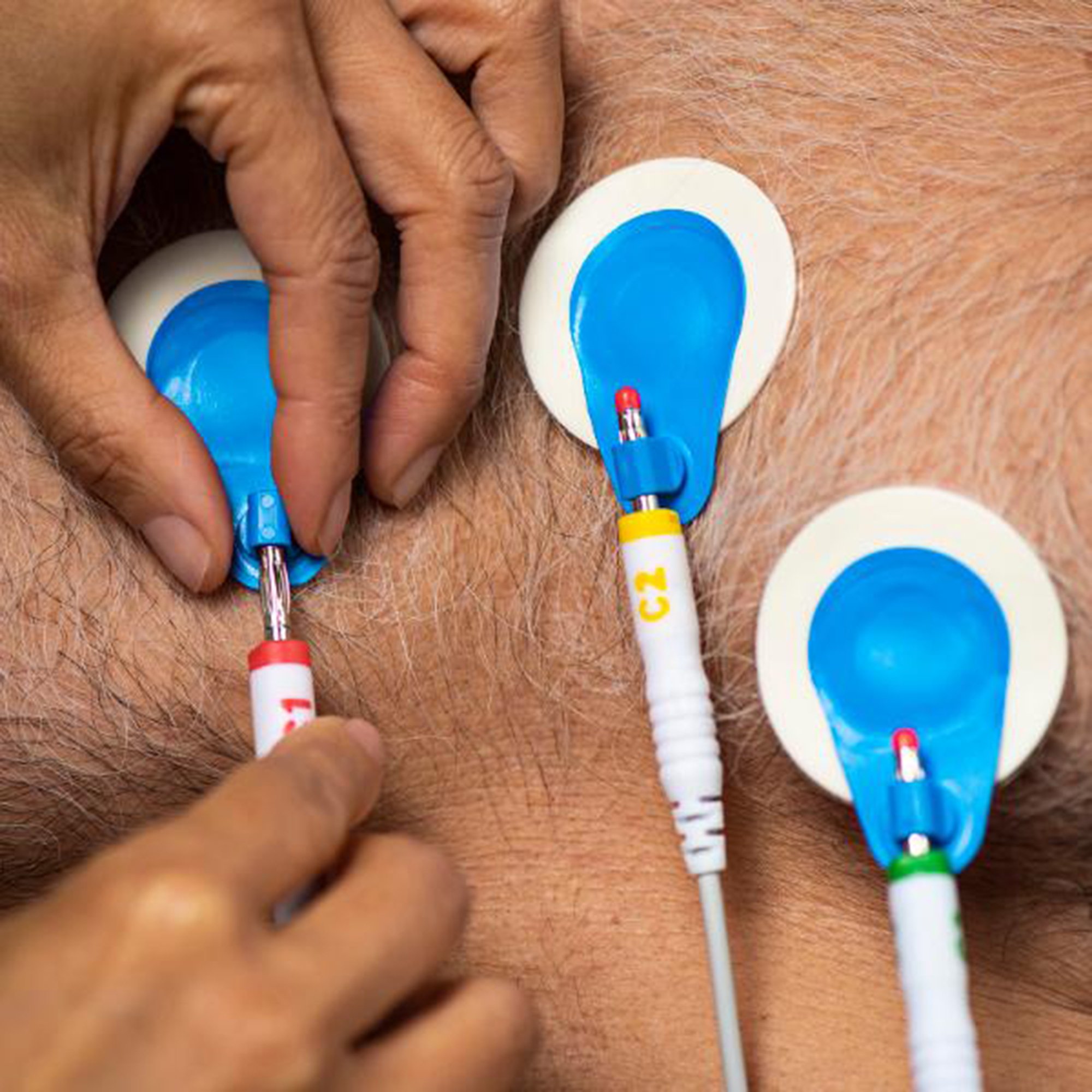 BlueSensor R ECG Stress Electrode R-00-S-4 by Ambu
