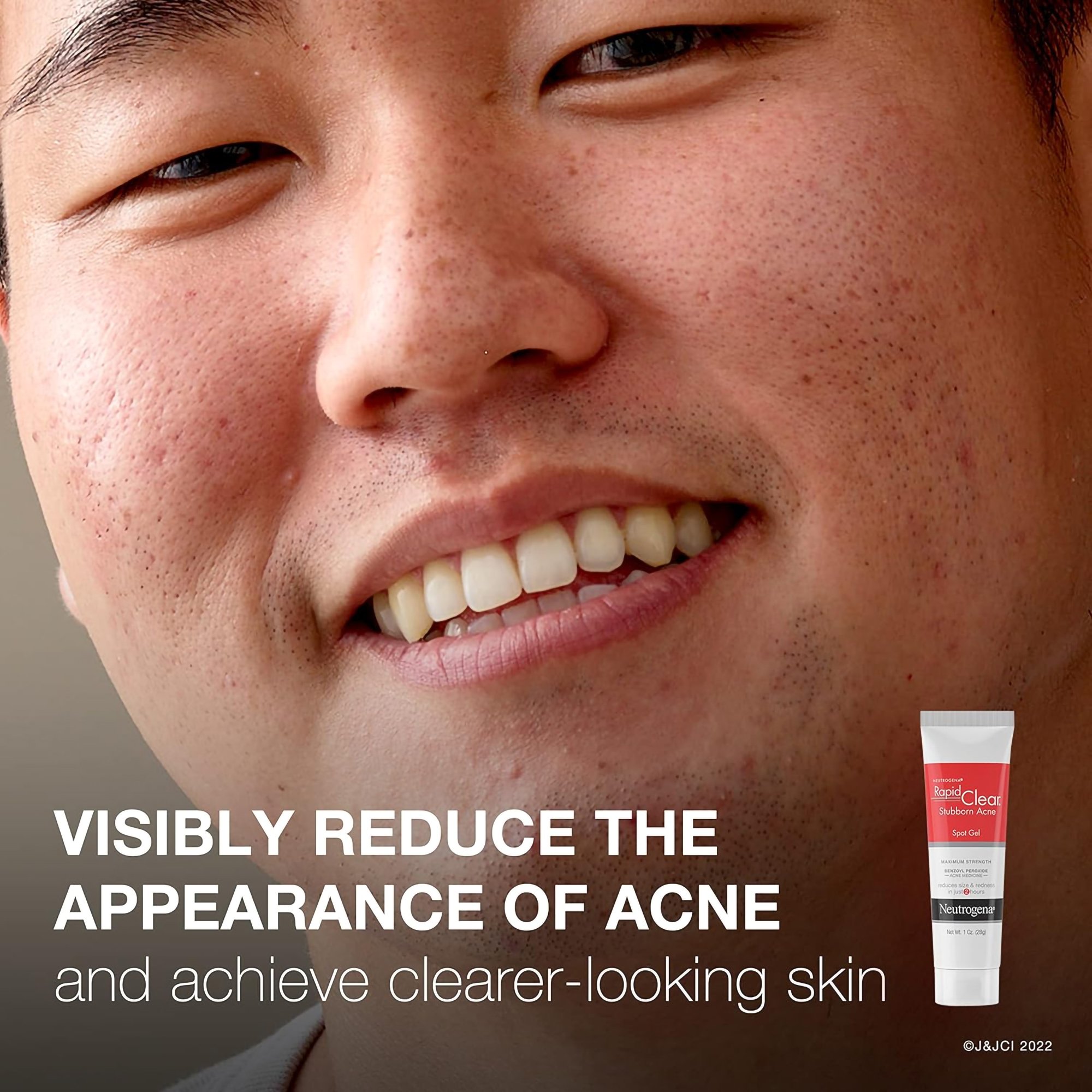 J & J Sales 69968004301 - Neutrogena® Rapid Clear Stubborn Acne Spot 10% Benzoyl Peroxide Gel, 1 ounce - 1/Each