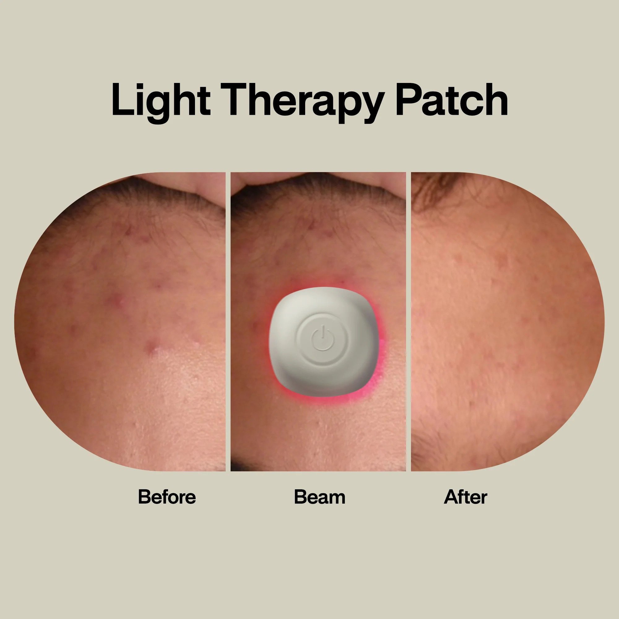 LED Technologies Inc ACPOD - LAB Acne Light Therapy Patch Acne Treatments with Lightpod and Four Hydrogrips - 1/Each, 96/Case