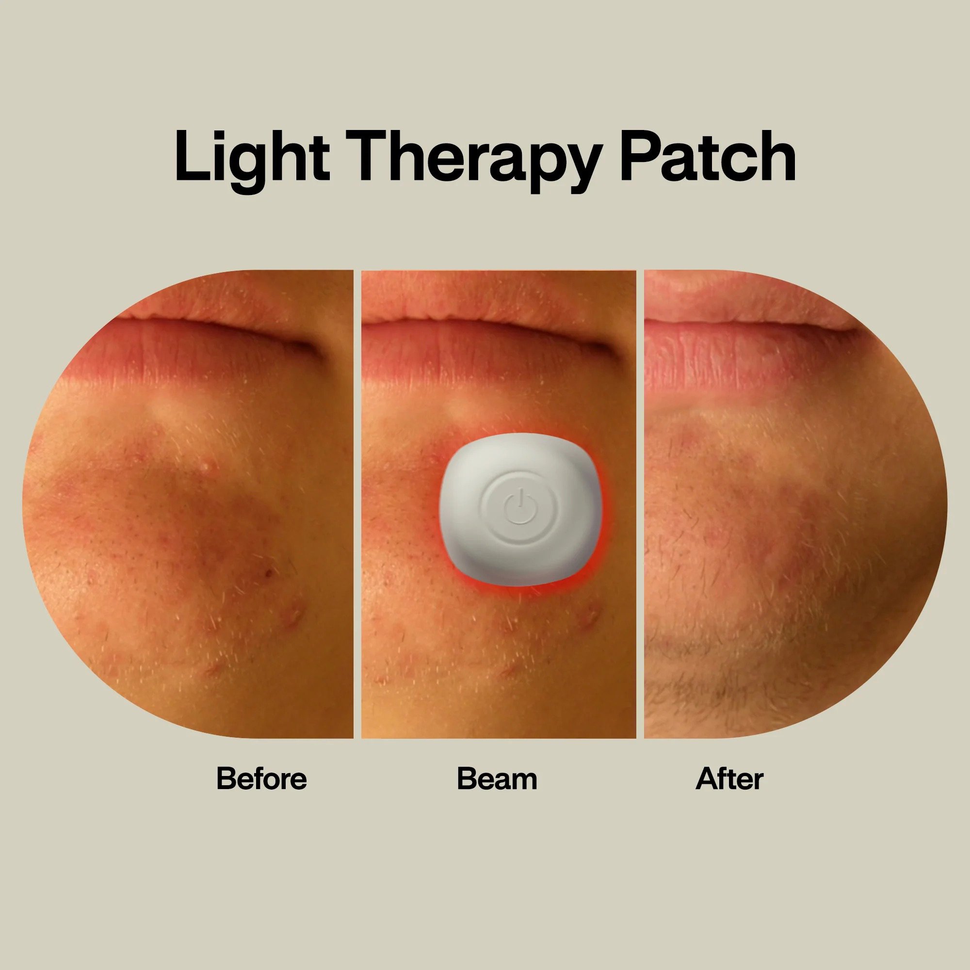LED Technologies Inc ACPOD - LAB Acne Light Therapy Patch Acne Treatments with Lightpod and Four Hydrogrips - 1/Each, 96/Case