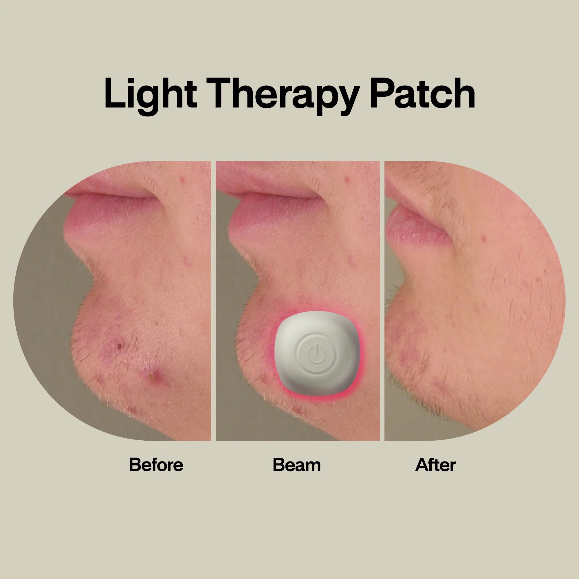 LED Technologies Inc ACDUO - LAB Acne Light Therapy Patch Acne Treatments w/ 2 Lightpods, 8 Hydrogrips, Case - 1/Each, 96/Case