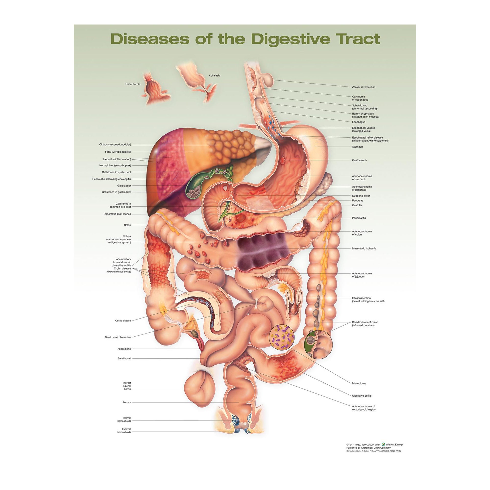 Wolter Kluwer Health Inc - 9781975243258 Anatomical Chart Diseases of the Digestive System, 2nd Edition 20 X 26 Inch Heavy Paper Frame / Hang Laminated