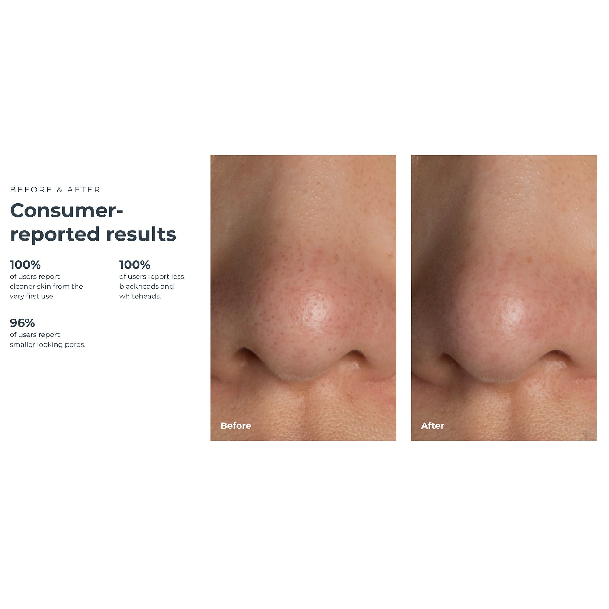 Foreo Inc - F1948 KIWI™ Blackhead Remover Pore Vaccum