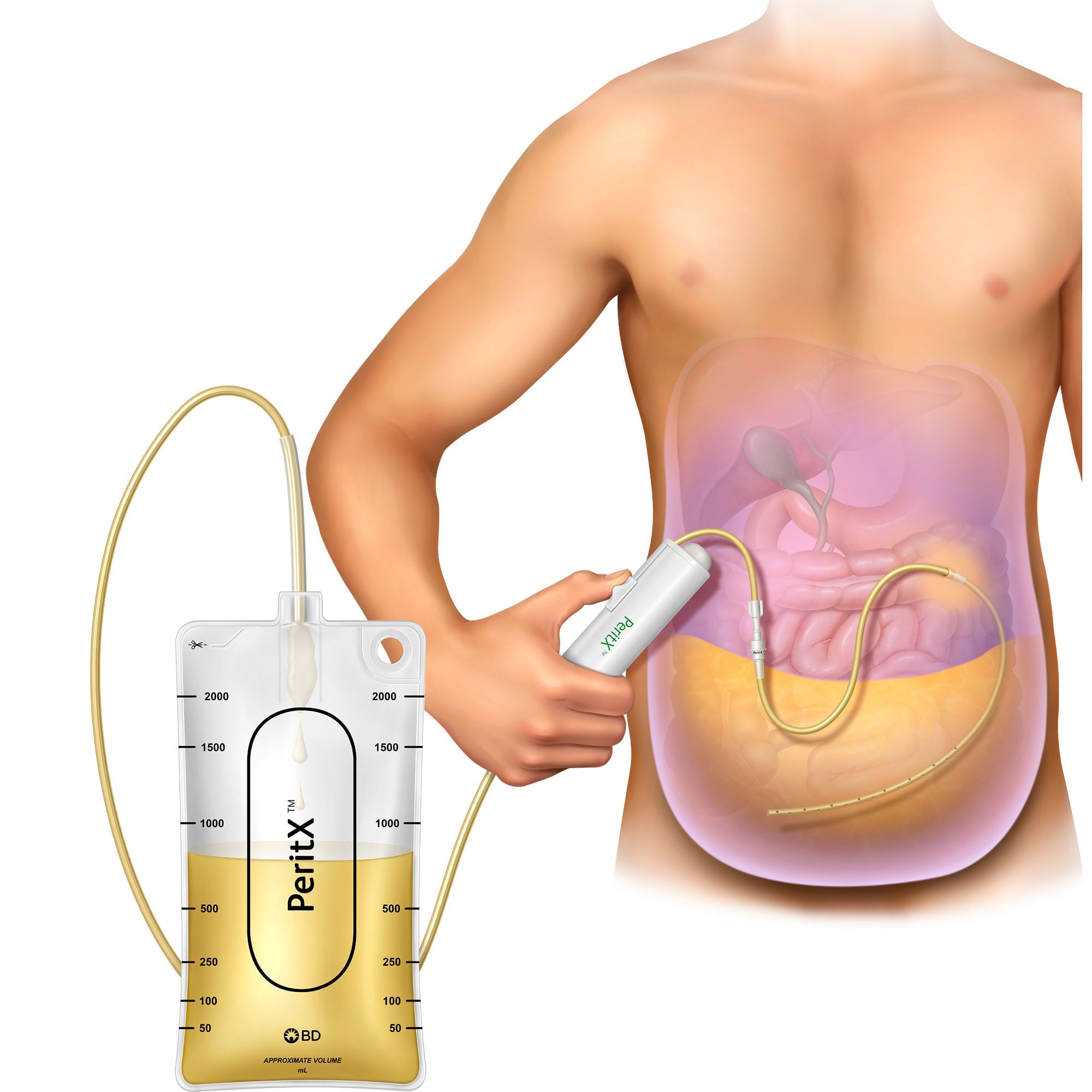 BD - 90-2010 Peritoneal Drainage Kit PeritX™