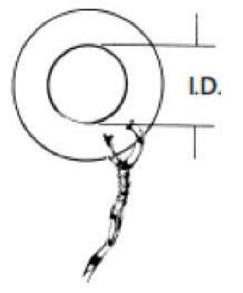 Olympus America Inc - 70241014 Olympus America Inc Ear Ventilation Tube