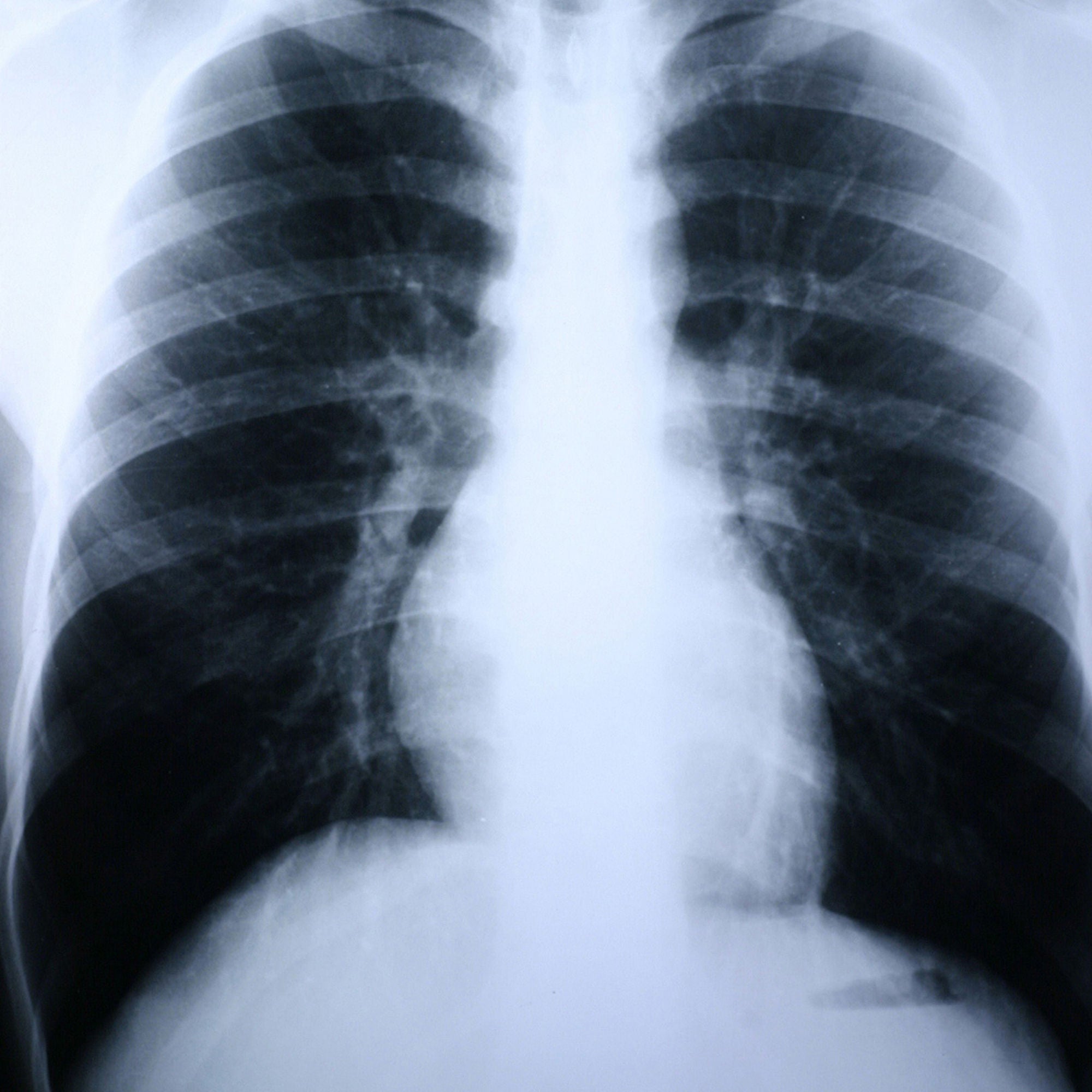 McKesson Brand - XDAMC Clear Choice™ Performance X-Ray Film