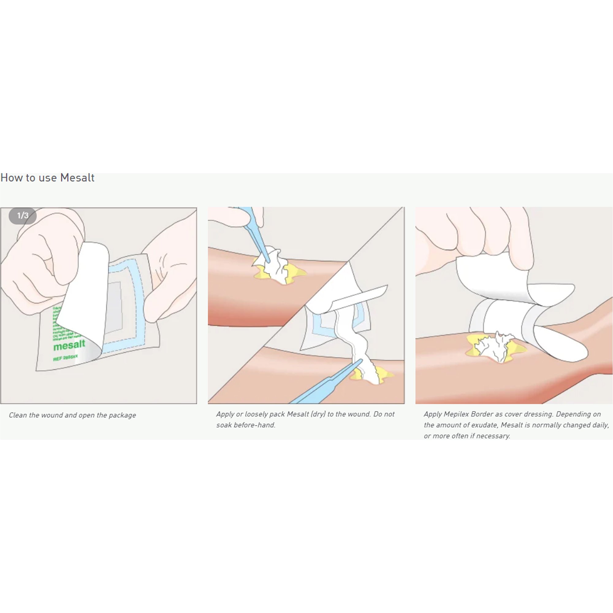 Molnlycke - 285780 Mesalt® Sodium Chloride Impregnated Dressing
