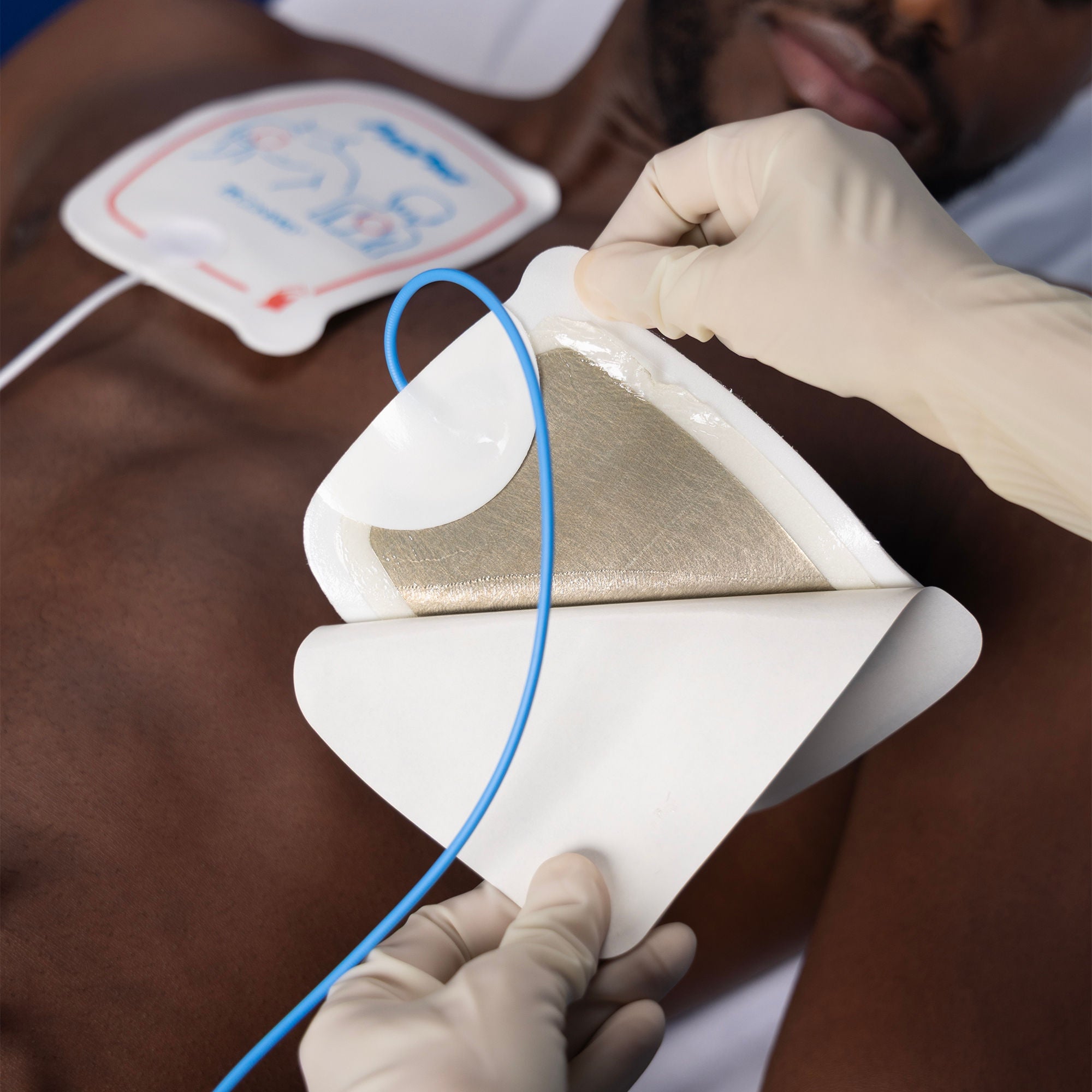 Conmed - 2001M AED Defibrillator Pad PadPro® Physio Connector Adult