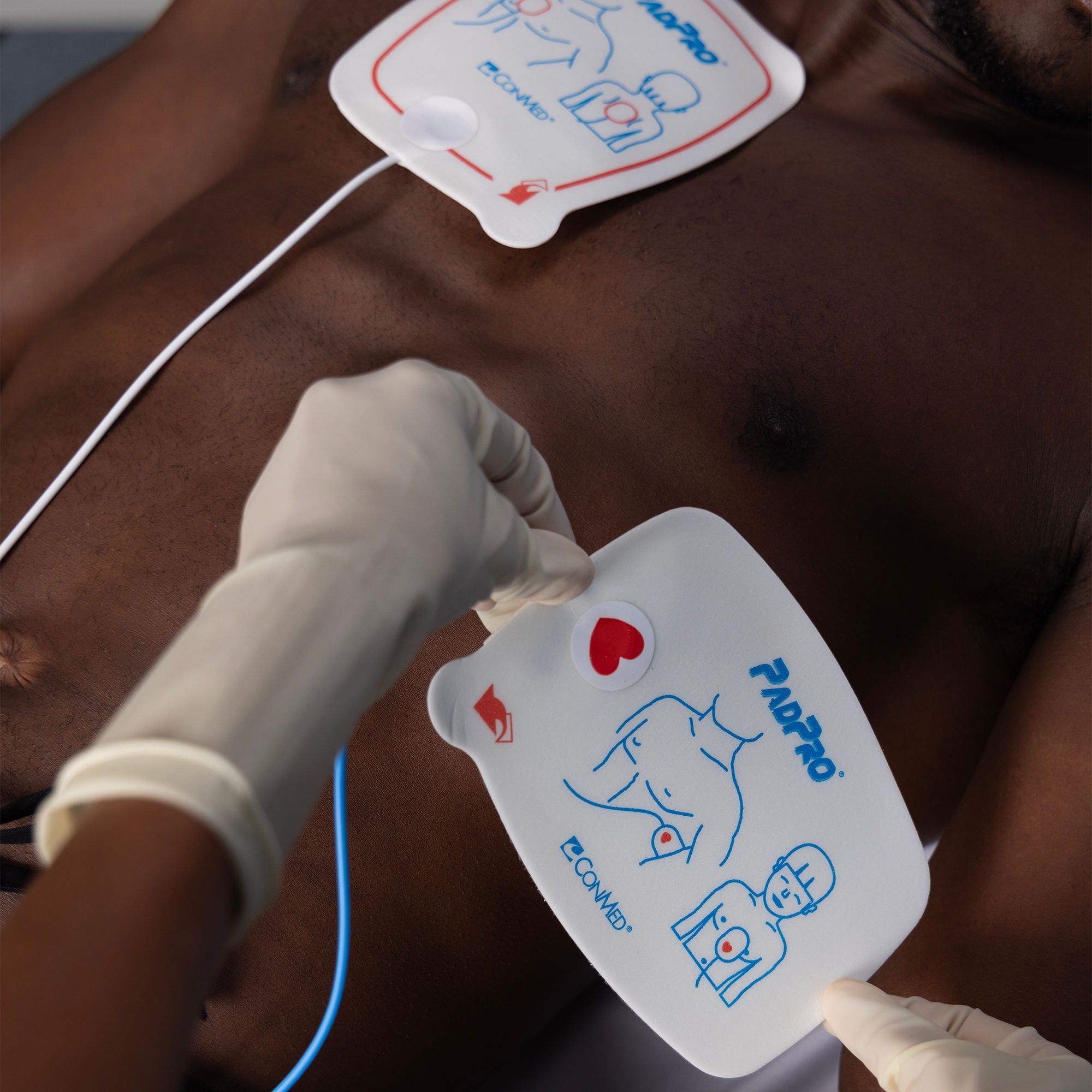 Conmed - 2001M AED Defibrillator Pad PadPro® Physio Connector Adult