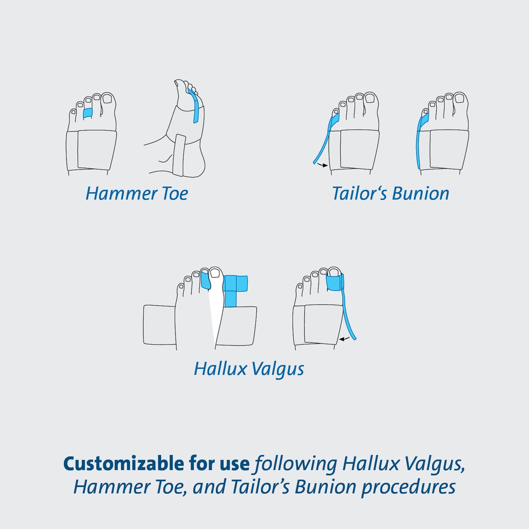 Darco International TAS - TAS™ Toe Splint, One Size Fits Most - 1/Each, 36/Case