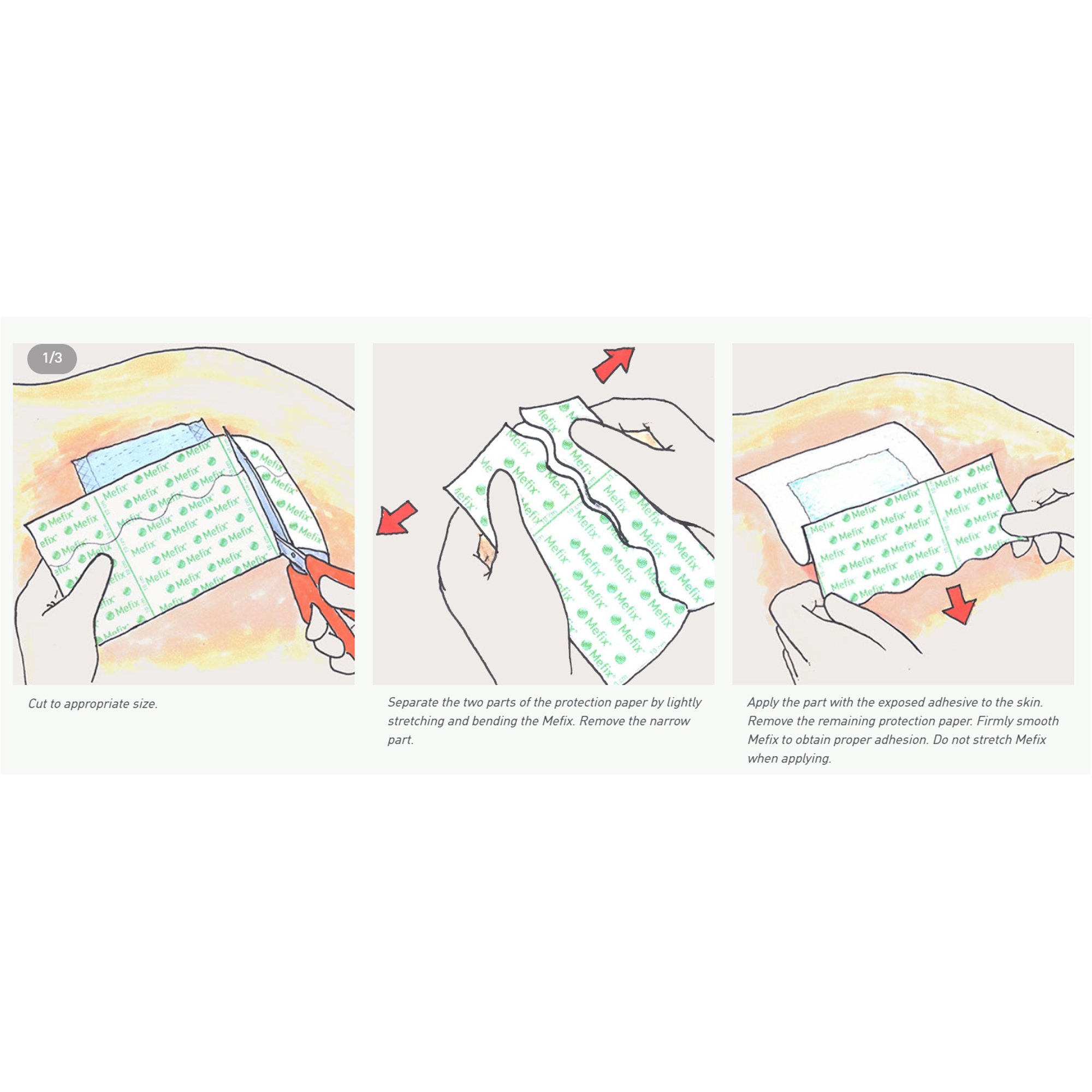 Molnlycke 310599 - Mefix® Nonwoven Dressing Retention Tape, 2 Inch x 11 Yard - 1/Box, 40/Case