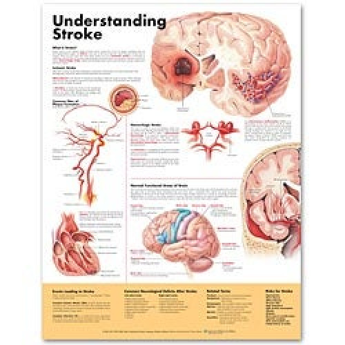 Wolter Kluwer Health Inc - 9781587799884 Anatomical Chart Understanding Stroke 20 X 26 Inch Heavy Paper Grommets Laminated