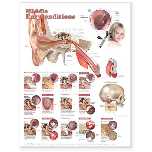 Wolter Kluwer Health Inc - 9781605470962 Anatomical Chart Middle Ear Conditions 20 X 26 Inch Heavy Paper Grommets Laminated