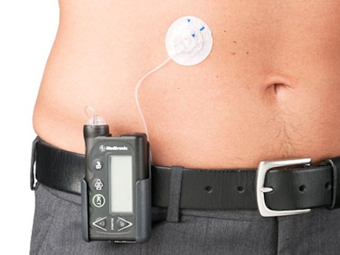 MiniMed Quick-set Insulin Infusion Set MMT-397A by Medtronic