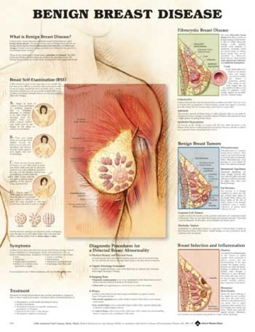 Wolter Kluwer Health Inc - 9781587796746 Anatomical Chart Benign Breast Disease 20 X 26 Inch Heavy Paper Grommets Laminated