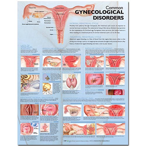 Wolter Kluwer Health Inc - 9780781773508 Anatomical Chart Common Gynecological Disorders 20 X 26 Inch Paper Grommets Laminated