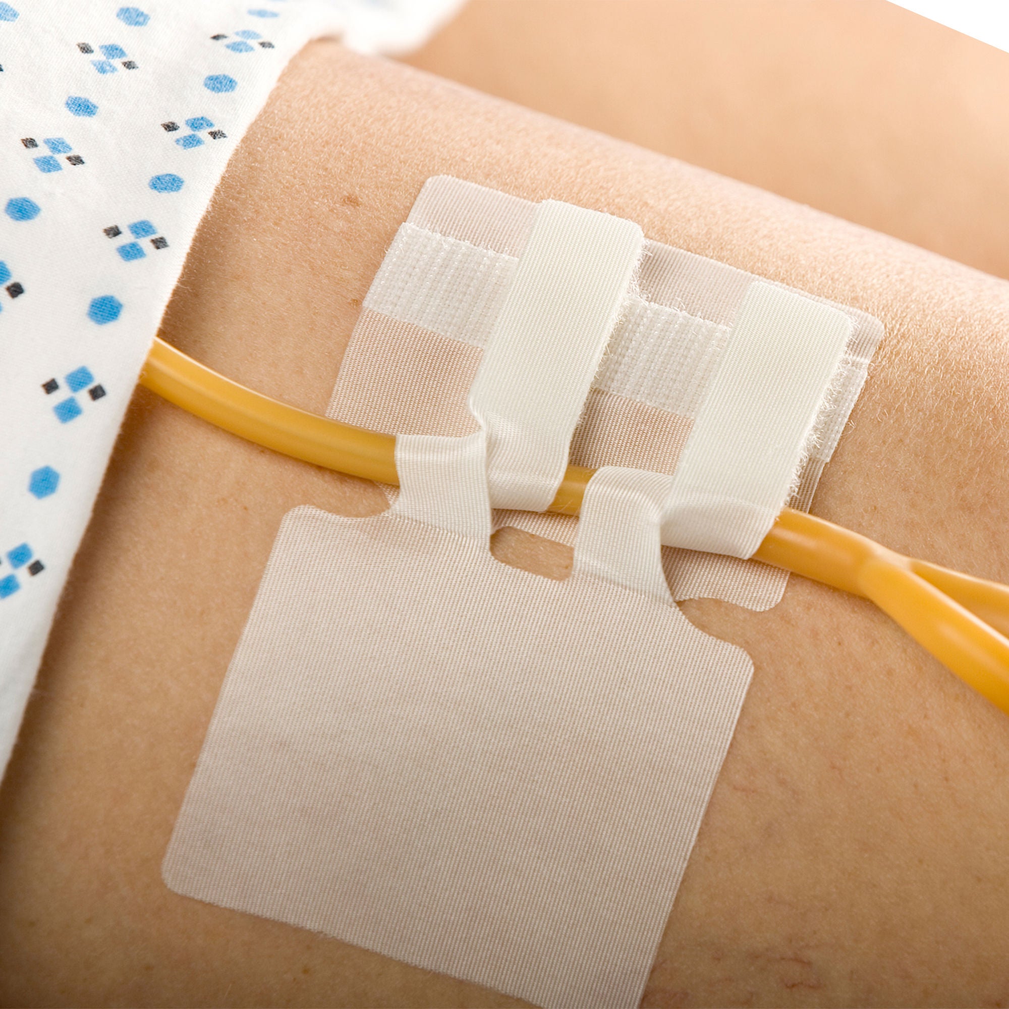 M.C. Johnson - 5445-4 Cath-Secure® Dual Tab Catheter Holder