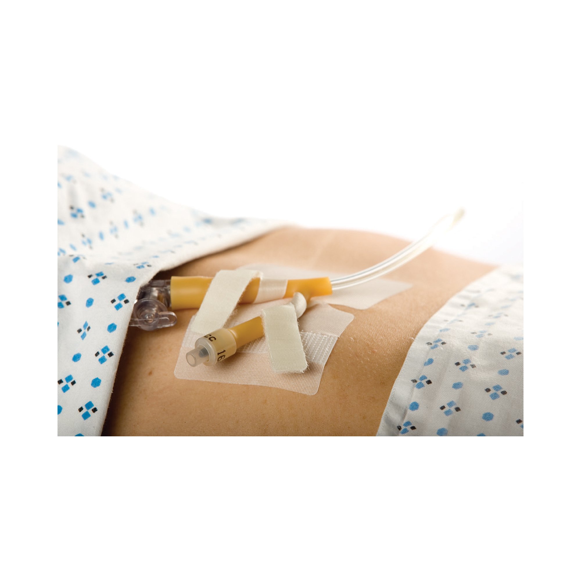 M.C. Johnson - 5445-4 Cath-Secure® Dual Tab Catheter Holder