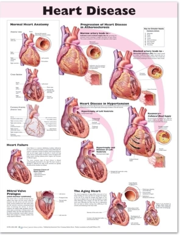Wolter Kluwer Health Inc - 9780781773386 Anatomical Chart Heart Disease 20 X 26 Inch Heavy Paper Grommets Laminated