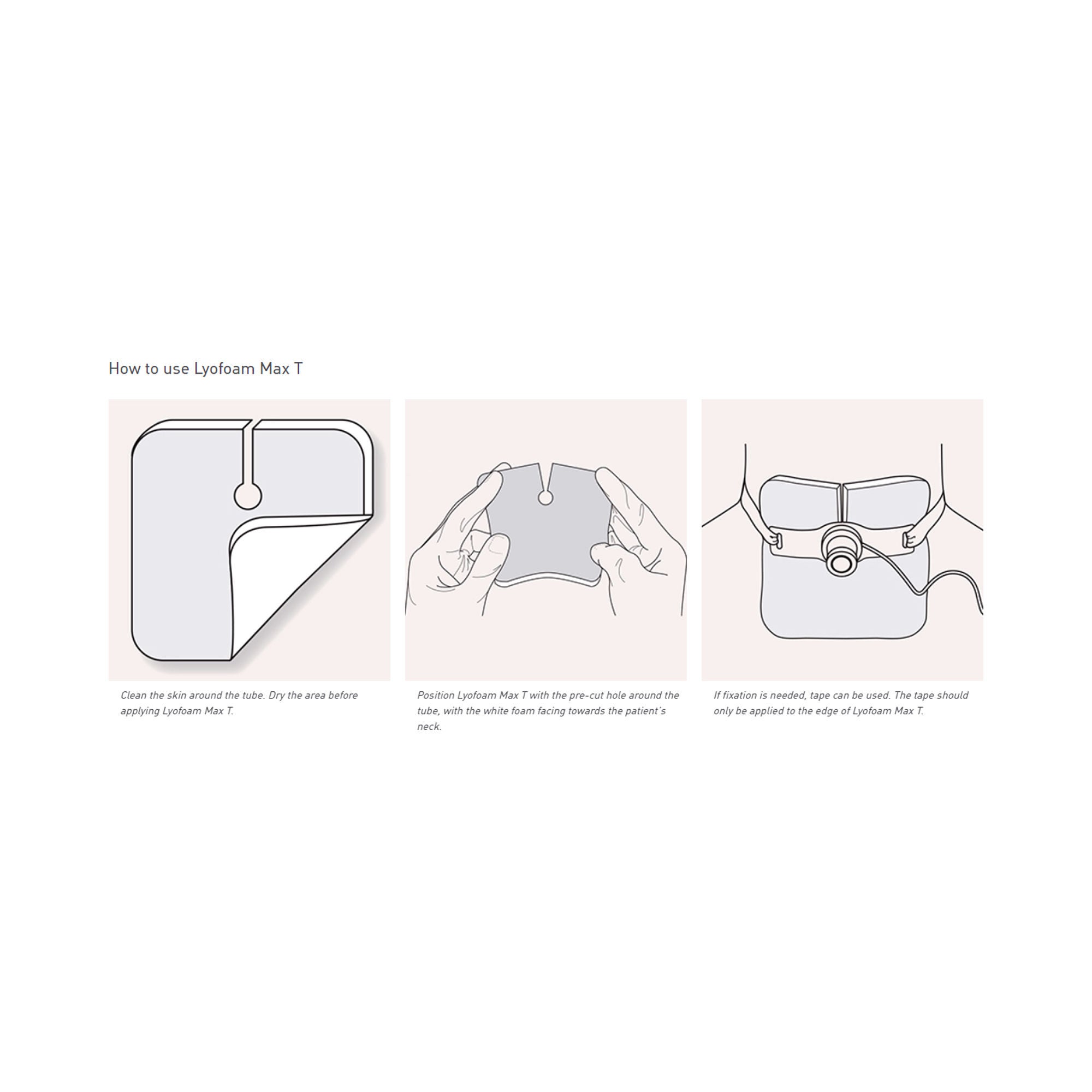 Molnlycke - 603207 Foam Dressing Lyofoam® Max T 3-1/2 X 3-1/2 Inch Without Border Film Backing Nonadhesive Fenestrated Square Sterile