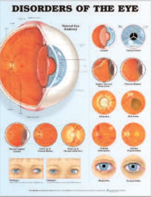Wolter Kluwer Health Inc - 9781587799259 Anatomical Chart Eye Disorder 20 X 26 Inch Heavy Paper Grommets Laminated