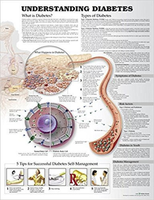 Wolter Kluwer Health Inc - 9781469894928 Anatomical Chart Understanding Diabetes 20 X 26 Inch Heavy Paper Grommets Laminated