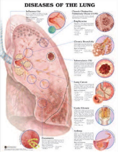 Wolter Kluwer Health Inc - 9781587799082 Anatomical Chart Lung Diseases 20 X 26 Inch Heavy Paper Grommets Laminated