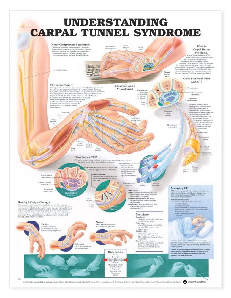 Wolter Kluwer Health Inc - 9781587793226 Anatomical Chart Carpal Tunnel Syndrome 20 X 26 Inch Heavy Paper Grommets Laminated