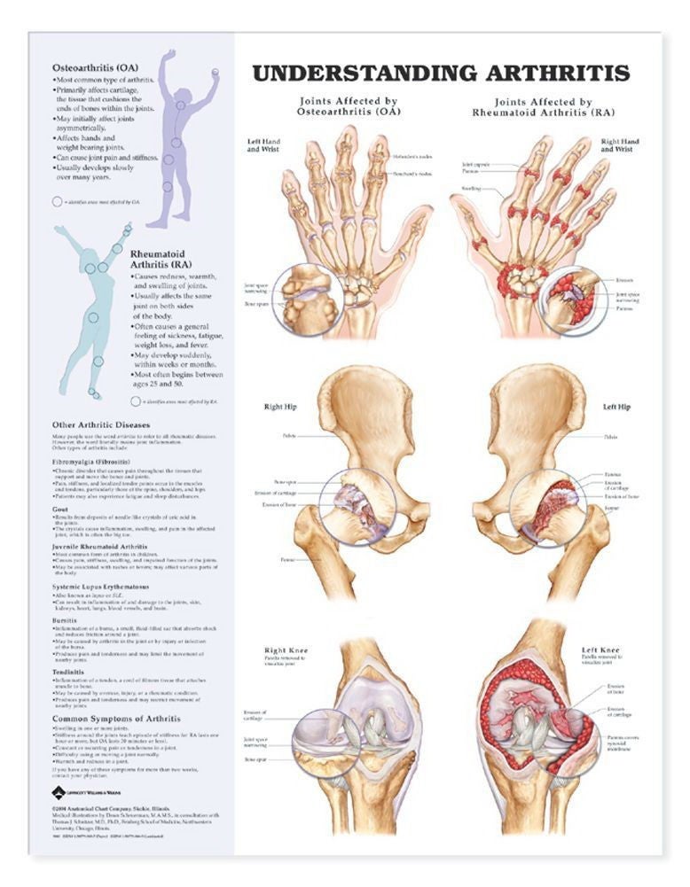 Wolter Kluwer Health Inc - 9781587793851 Anatomical Chart Arthritis 20 X 26 Inch Heavy Paper Grommets Laminated