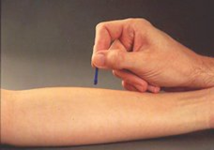 Morrow Brown Allergy Testing Needle MB-5 by Alkaline