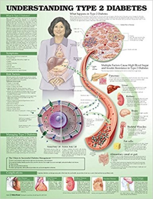 Wolter Kluwer Health Inc - 9781469894980 Anatomical Chart Type 2 Diabetes 20 X 26 Inch Heavy Paper Grommets Laminated