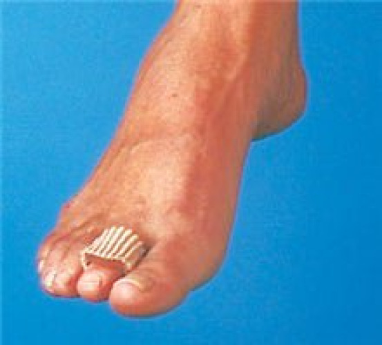 Alimed - 2970003757 Digit Pad Silopad™ Small / Medium Pull-On Toe