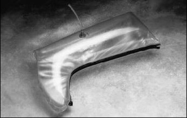 Allied Healthcare - S504 First Aid Splint Air Splint