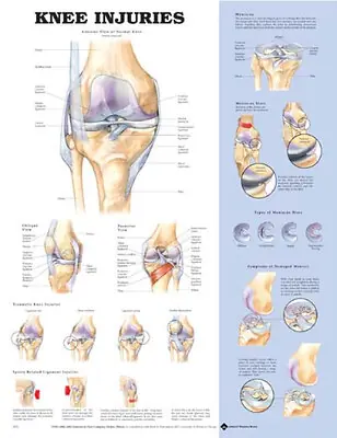 Wolter Kluwer Health Inc - 9781587797576 Anatomical Chart Knee Injuries 20 X 26 Inch Heavy Paper Laminated