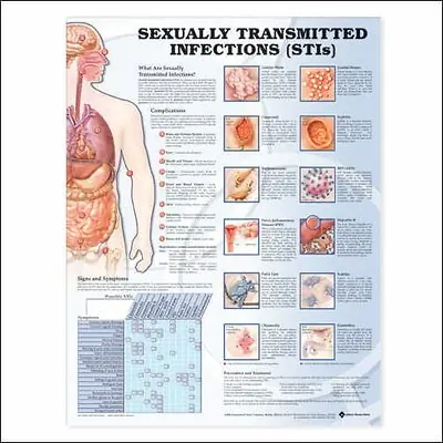 Wolter Kluwer Health Inc - 9781587798504 Anatomical Chart Sexually Transmitted Infections (STIS) 20 X 26 Inch Plastic Wall Mount Laminated