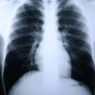 McKesson Brand - 55BN7 Clear Choice™ Performance X-Ray Film